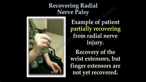 Radial Nerve Palsy ,Recovering . Part II- Everything You Need To Know ...