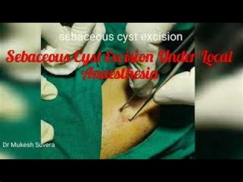 Sebaceous cyst excision / Excision under LA / OPD Procedure - YouTube