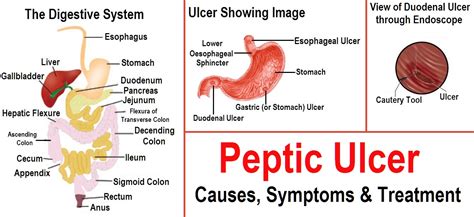 Peptic Ulcer Disease System Disorder Template