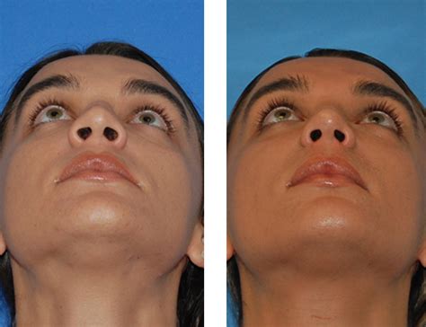 Nostril Reduction | Saigal Facial Plastic Surgery