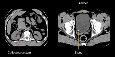 Kidney Stone Cat Scan