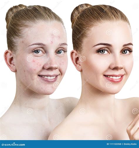 Young Woman with Acne before and after Treatment. Stock Photo - Image of caucasian, clean: 111153358