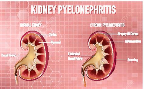 Ilustración Informativa De La Pielonefritis Anatomía Fisiológica Pielonefritis Vector PNG ...