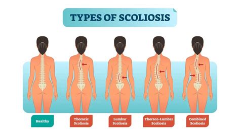 Scoliosis: Spine Deformity and Disability