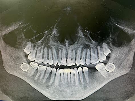 Impacted Third Molars, A Rare Occurrence of Identical Bilateral Impacted Mandibular Third Molars ...