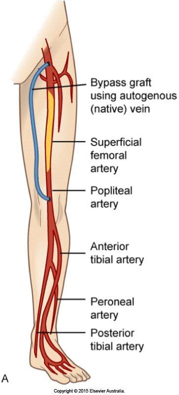 Femoral–popliteal bypass graft around an occluded superficial femoral artery. | Vascular surgery ...