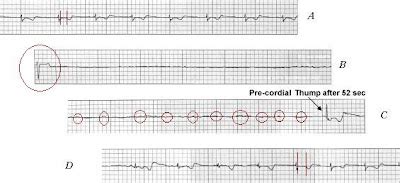 Precordial Thump - For Asystole? - ECG Strips - Rogue Medic