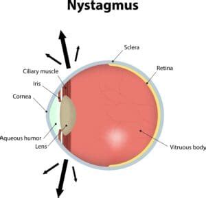 Nystagmus: Causes, Symptoms & Effective Treatment | NVISION Eye Centers