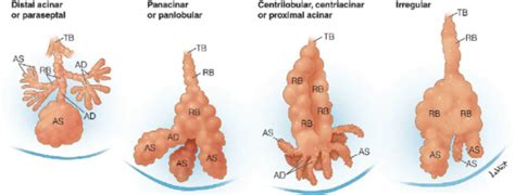 Emphysema Histology Comparison