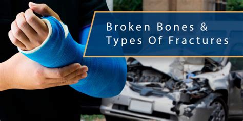Broken Bones & Types of Fractures From Motor Vehicle Collisions
