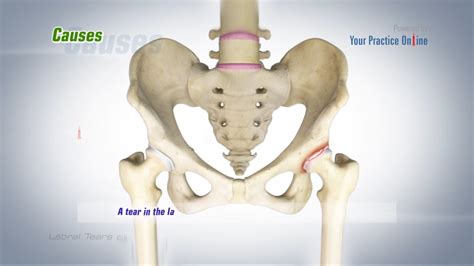 Hip Labral Tear Treatment