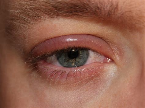 Eyelid Infection | New Health Guide