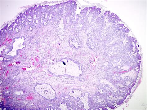 Pathology Outlines - Endocervical polyp