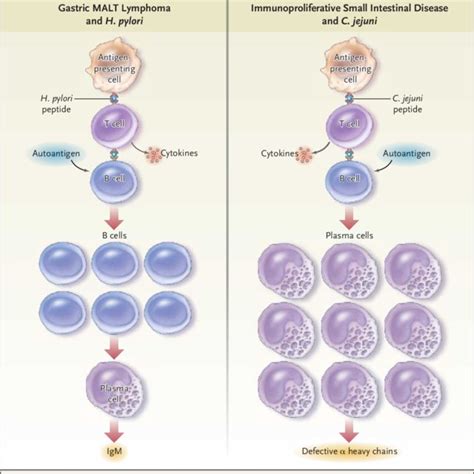 Figure. The Pathogenesis of Gastric MALT Lymphoma (Panel A) and... | Download Scientific Diagram