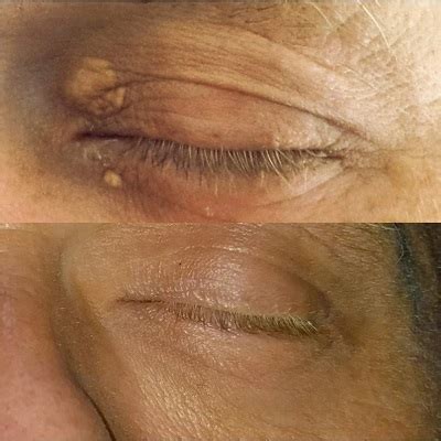 Xanthelasma Removal Cream