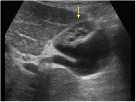 Abdomen and retroperitoneum | 1.2 Gallbladder and bile ducts : Case 1.2 ...