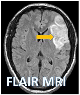 Broca's Aphasia & Stroke - Sumer's Radiology Blog