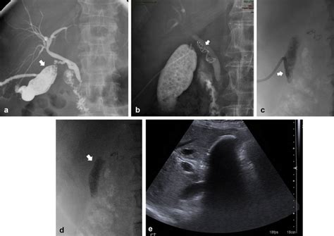 post ablation syndrome treatment