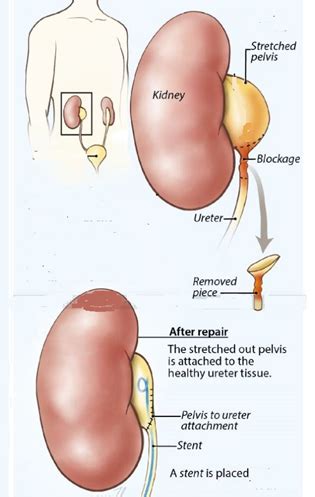 Robotic Pyeloplasty | Chin Chong Min Urology & Robotic Surgery Centre