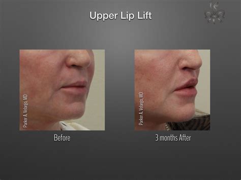 Lip Augmentation & Reduction | New Orleans Center for Aesthetics and Plastic Surgery