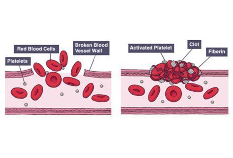 IGCSE Biology Notes: 2.62: Understand that Platelets are Involved in Blood Clotting, Which ...