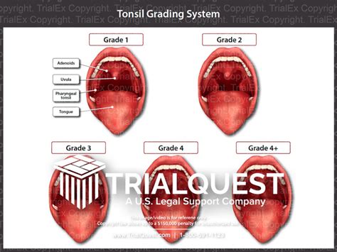 Tonsil Grading System - Trial Exhibits Inc.