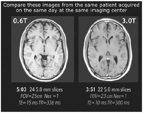 Misunderstanding field strength | Washington Open MRI