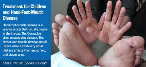 Treatment for Children and Hand-Foot-Mouth Disease - Pediatric ...