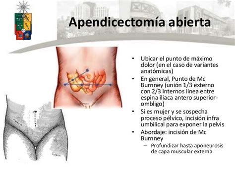 Apendicectomía abierta y vlp