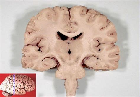 About Brain Atrophy in MS | HubPages