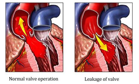 Aortic Regurgitation | Heart and Vascular Care | New Jersey