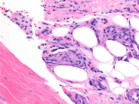 Eosinophilic Fasciitis (Shulman Disease, Diffuse Fasciitis with Eosinophilia)