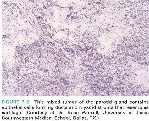 Parotid tumor | Tumor, Pathology, Parotid gland