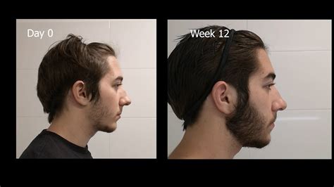 Minoxidil Before And After Beard Result / Minoxidil Beard Before And ...