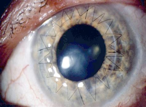 Eye after cornea transplant [IMAGE] | EurekAlert! Science News Releases