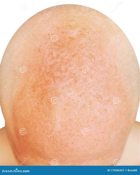 Age Spots on the Bald Head of a Man from Sunburn Stock Image - Image of close, medicine: 175596457