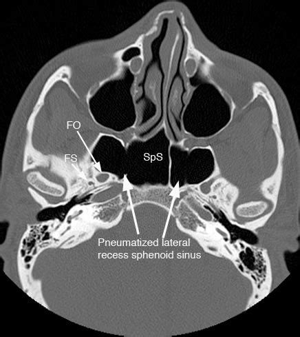 Sphenoid Sinus: Normal Anatomy & Variants