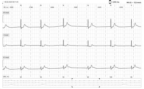 Junctional Bradycardia Rhythm Strip