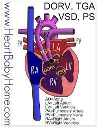 dorv heart defect - Google Search | Coarctation of the aorta, Congenital heart disease ...