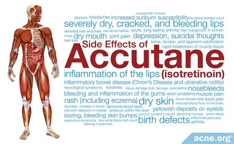 What are the side effects of Accutane (isotretinoin)? - Acne.org