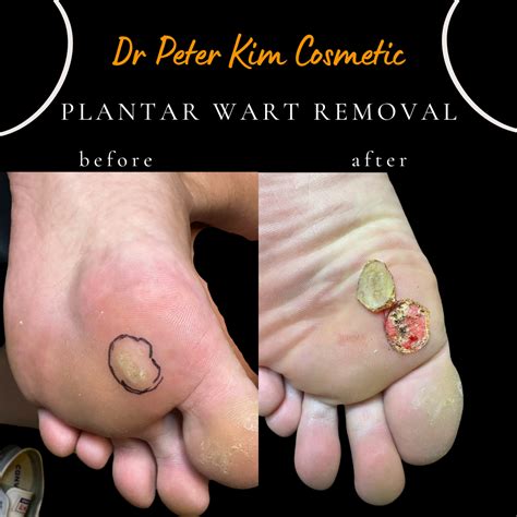 Laser Wart Removal & Treatment Sydney - Finger warts, Plantar warts, Genital Warts, Toe warts ...