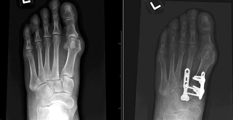 www.lisfranc.ca - Lisfranc Fracture / Injury Blog