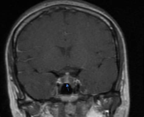 Pituitary Tumor Mri