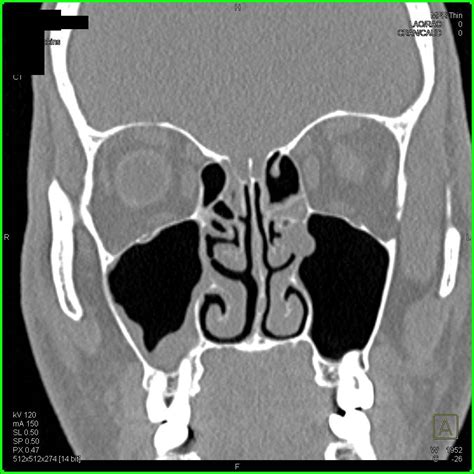 D Of Mucosal Thickening Of Maxillary Sinus On Right Neuro Case | My XXX Hot Girl