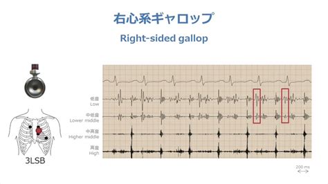 A right-sided gallop rhythm - YouTube