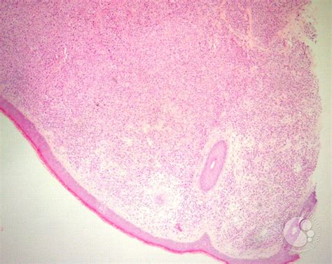 Cutaneous lesions in systemic mastocytosis - 1.