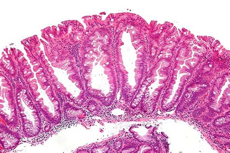 Risk Factors for Sessile Serrated Polyps and Adenomas - Focus on ...