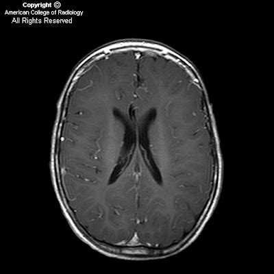 Neuroradiology On the Net: Pelizaeus Merzbacher disease (PMD)