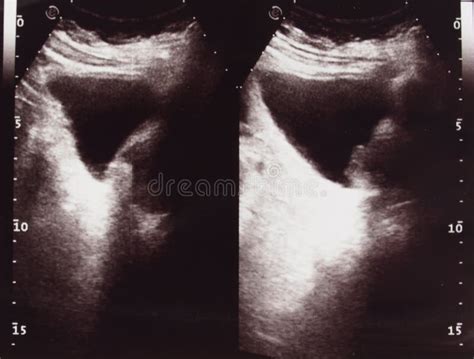 Diagnostic Sonography of Abdomen Stock Image - Image of visualizing ...