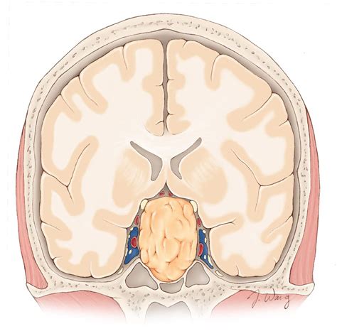 Pituitary Tumor | Expert Surgeon | Aaron Cohen-Gadol MD